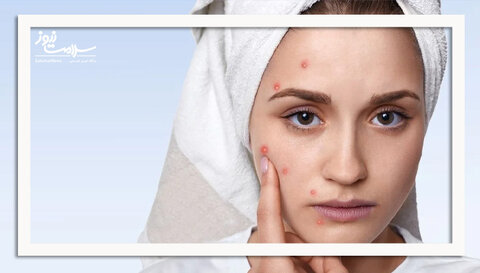 رژیم غذایی برای کنترل آکنه هورمونی: چه بخوریم و چه نخوریم؟