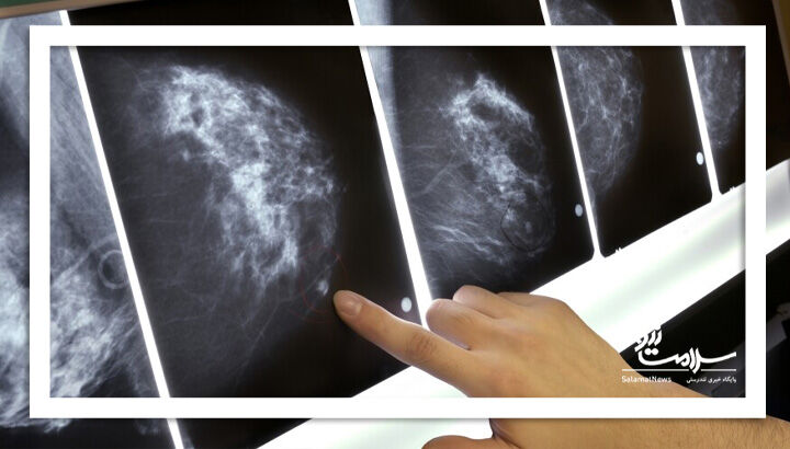 تغییر سبک زندگی راهکار غلبه بر سرطان/ماموگرافی، نقش کلیدی در تشخیص زودهنگام سرطان پستان
