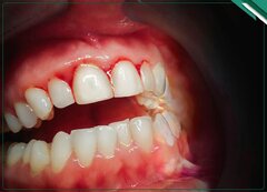 تحلیل لثه در ارتودنسی؛ راهنمای جامع دلایل و راهکارها