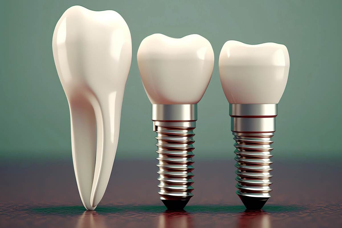 صفر تا صد مراحل ایمپلنت دندان + نکات مهم مراقبتی