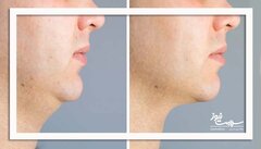 چگونه از غبغب خلاص شویم؟