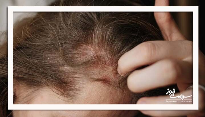  دلایل، علائم و روش‌های درمان خارش پوست سر