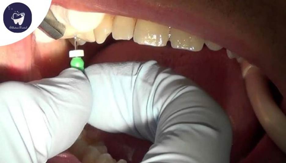 آیا ممکن است عفونت ریشه دندان پس از عصبکشی برگردد؟