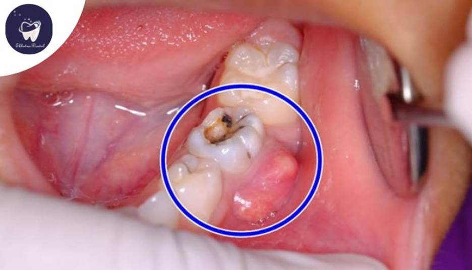 آیا ممکن است عفونت ریشه دندان پس از عصبکشی برگردد؟