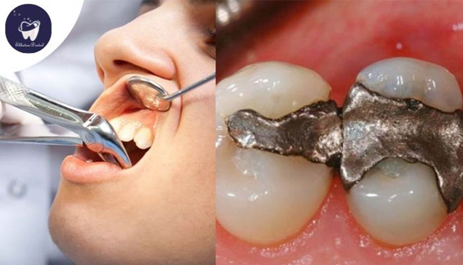 آیا ممکن است عفونت ریشه دندان پس از عصبکشی برگردد؟