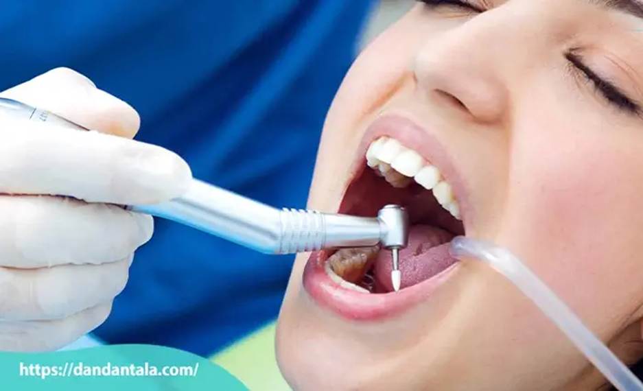 فرق لمینت و کامپوزیت کدام بهتر است؟