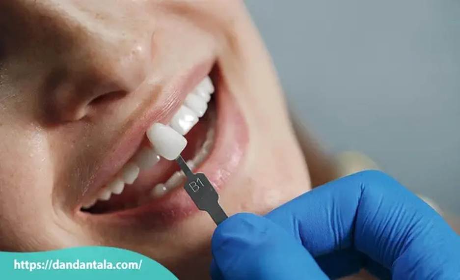 فرق لمینت و کامپوزیت کدام بهتر است؟