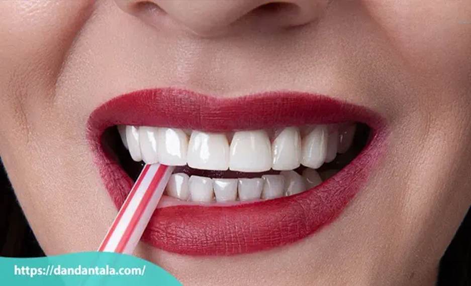 فرق لمینت و کامپوزیت کدام بهتر است؟