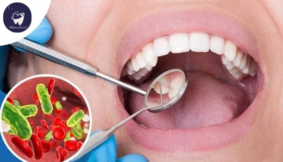 آیا ممکن است عفونت ریشه دندان پس از عصب‌کشی برگردد؟