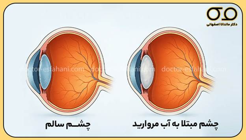 اگر آب مروارید را جدی نگیرید، ممکن است بینایی خود را برای همیشه از دست بدهید.