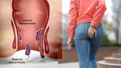 لیزر بواسیر؛ راهکار پایان دردهای همیشگی در بیماری های نشیمنگاهی