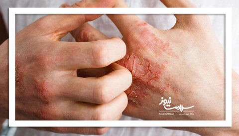 اگزمای شدید بی‌خوابی می‌آورد
