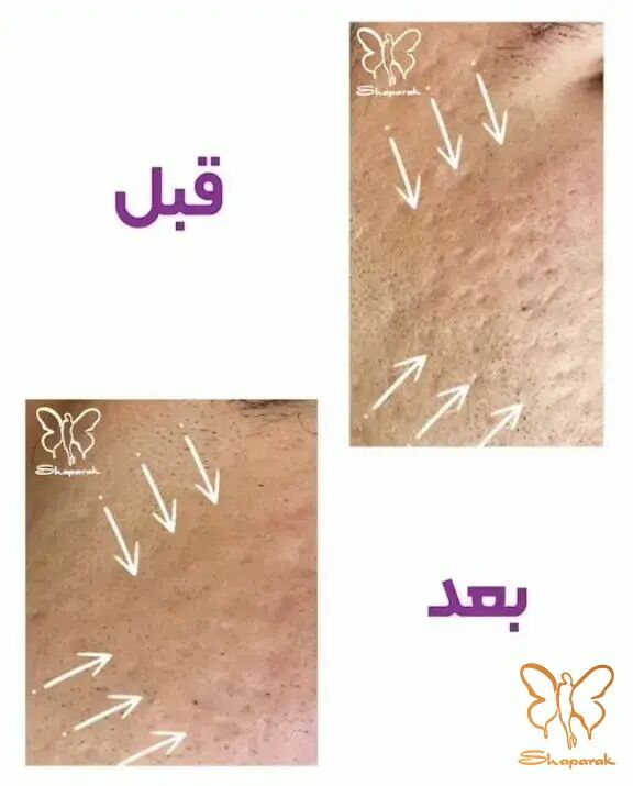 فوتونا فرکشنال یا فوردی؟ جوانسازی بدون جراحی و رفع جای جوش با لیزر فوتونا در مشهد