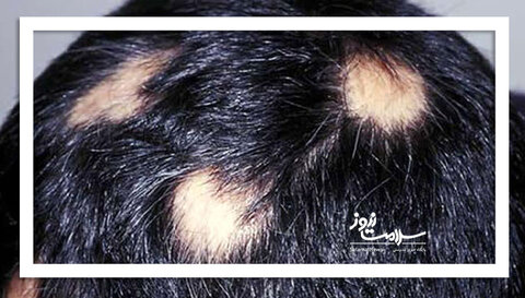 حمله سیستم ایمنی به فولیکول‌های مو