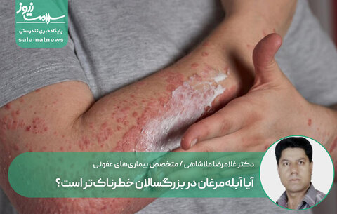 آیا آبله‌مرغان در بزرگسالان خطرناک‌تر است؟