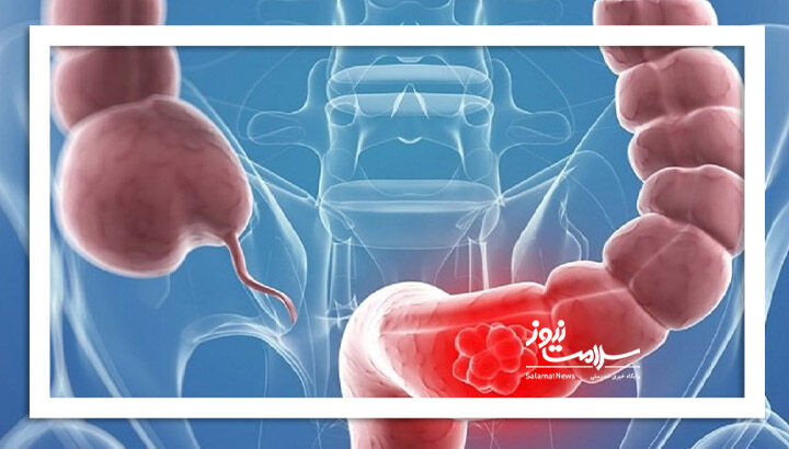 تشخیص ۹۰٪ سرطان روده با یک آزمایش ساده؛ هوش مصنوعی در آستانه کنار زدن کولونوسکوپی تشخیص ۹۰٪ سرطان روده با یک آزمایش ساده؛ هوش مصنوعی در آستانه کنار زدن کولونوسکوپی