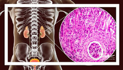 گلومرولواسکلروز فوکال سگمنتال (FSGS) چیست؟