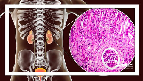گلومرولواسکلروز فوکال سگمنتال (FSGS) چیست؟
