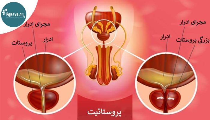 آیا بزرگی پروستات می تواند بر روی باروری شما تاثیر بگذارد؟