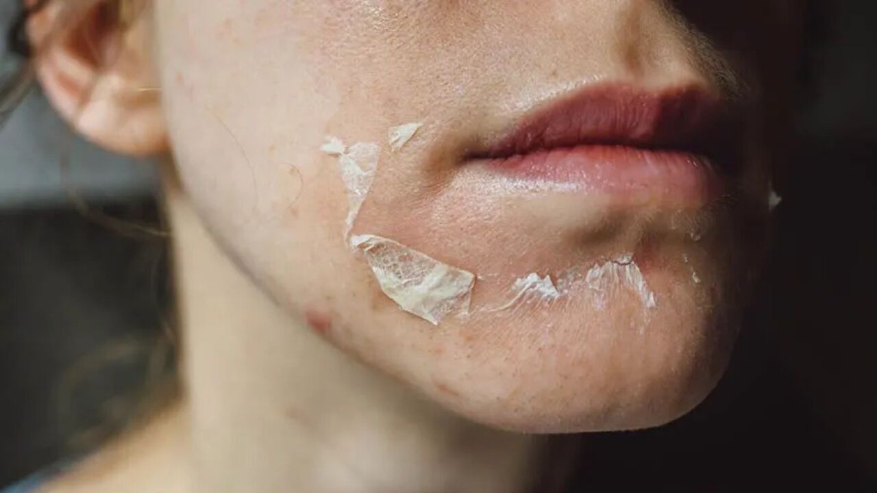 عوارض اسیدتراپی پوست صورت؛ چه زمانی باید نگران باشیم؟