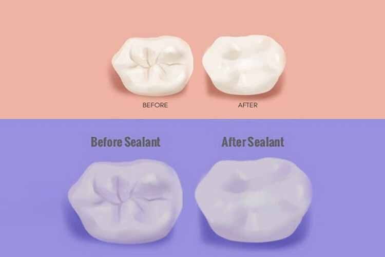 فیشور سیلانت چیست ؟