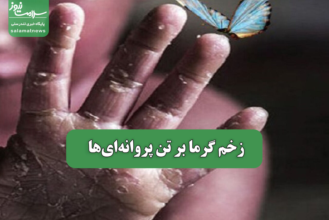 زخم گرما بر تن پروانه‌ای‌ها