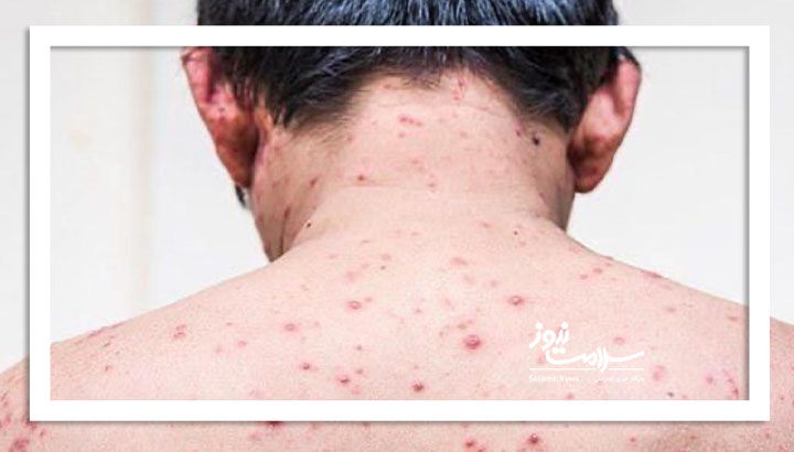 راه درمان جوش کمر چیست؟ راه درمان جوش کمر چیست؟