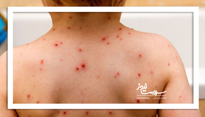 واکسن آبله مرغان بزنیم یا نزنیم؟ واکسن آبله مرغان بزنیم یا نزنیم؟