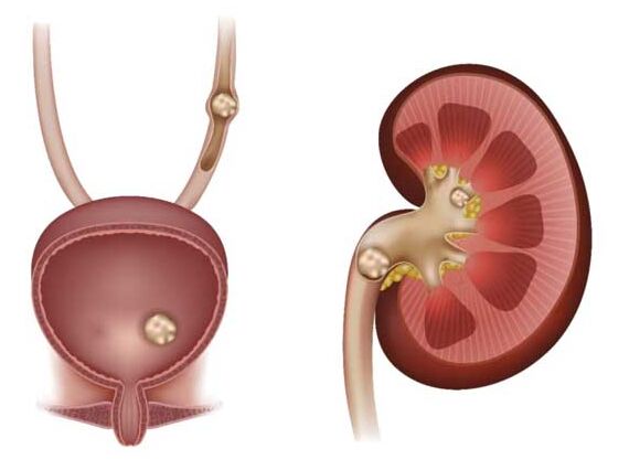 راهنمای جامع بیماری‌های شایع اورولوژی: از دفع سنگ کلیه تا جراحی پروستات و واریکوسل
