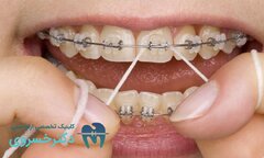 مراقبت از ارتودنسی در طول زمان