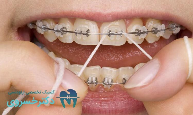 مراقبت از ارتودنسی در طول زمان