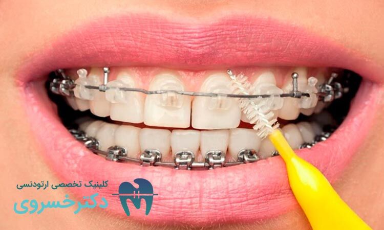 مراقبت از ارتودنسی در طول زمان