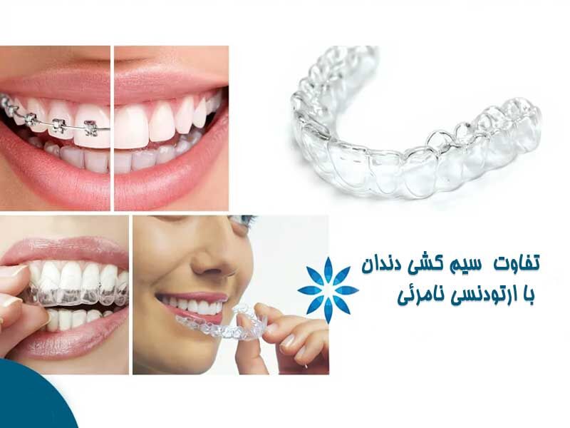 تفاوت بین ارتودنسی معمولی (با نگین و سیم) و ارتودنسی نامرئی
