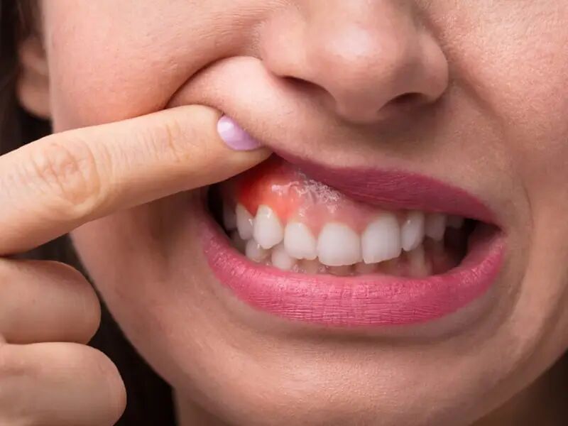 سوختگی لثه بعد از بلیچینگ سوختگی لثه بعد از بلیچینگ