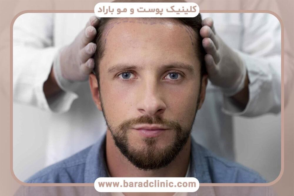 چگونه کاشت مو می‌تواند چهره را جوان کند؟