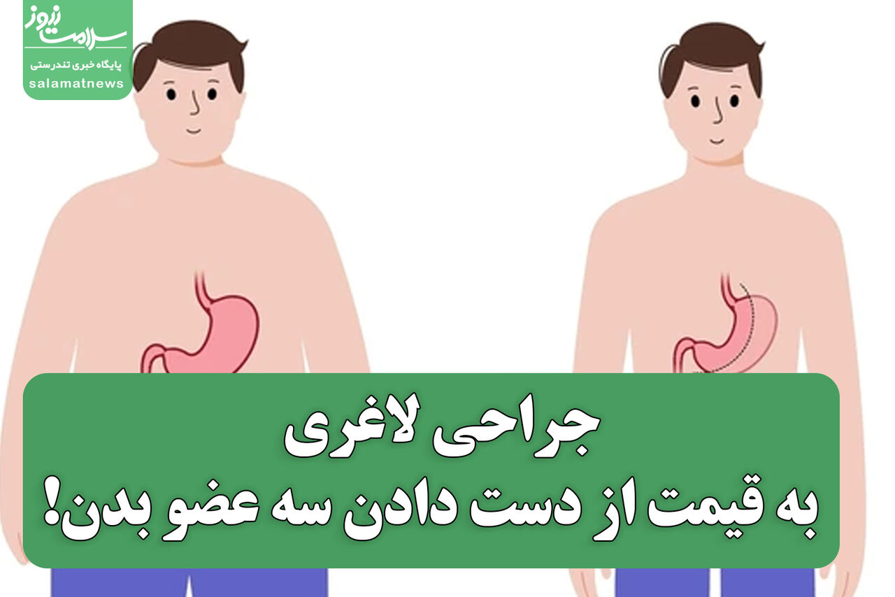 جراحی لاغری به قیمت از دست دادن سه عضو بدن!