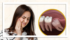 ۱۲ غذای مناسب پس از جراحی دندان عقل