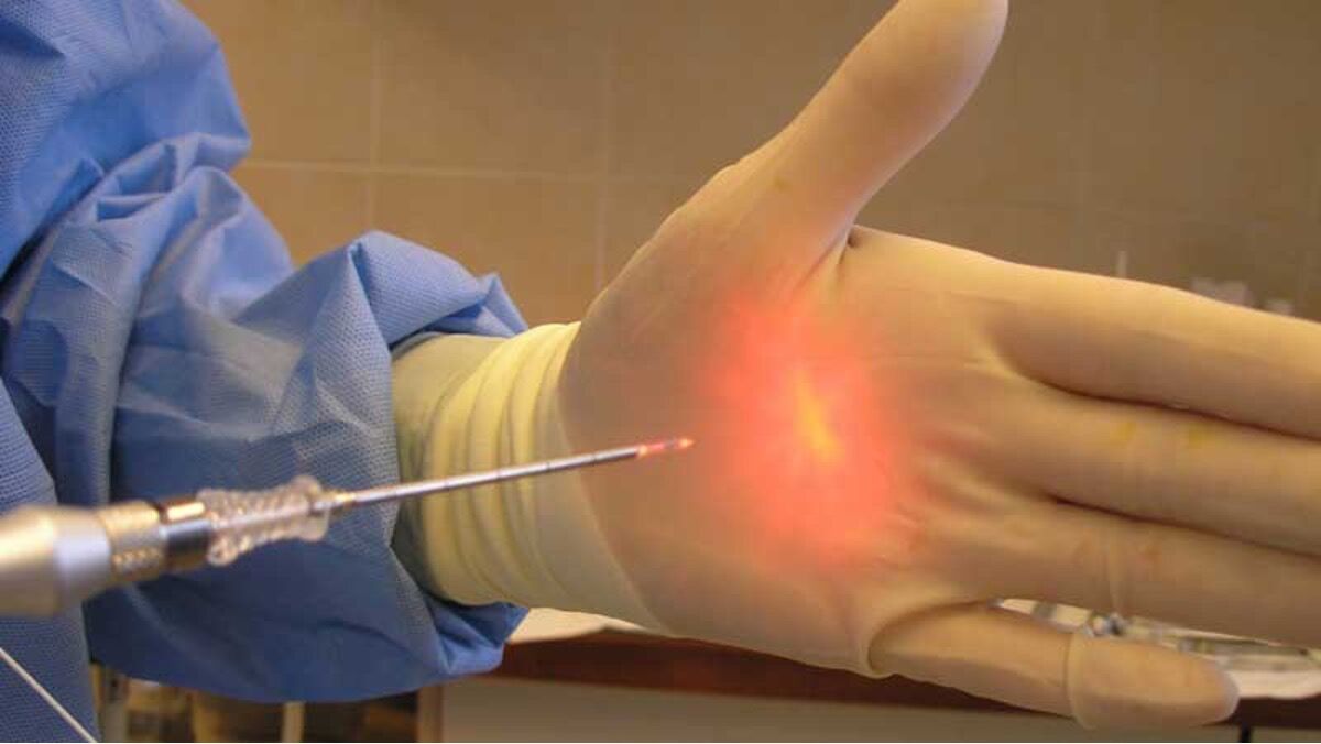 لیزر هموروئید؛ روشی قطعی و فوری