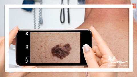 ویزیت پوست با یک عکس/آینده تله‌درماتولوژی در کشور