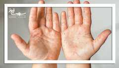 تب برفکی: بیماری‌ ایمن از انتقال به انسان / نظارت‌های دقیق دامپزشکی محصولات آلوده را از بازار خارج می‌کند