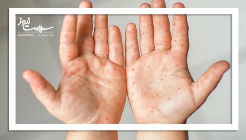 واکسن داخلی تب برفکی به زودی توزیع می شود