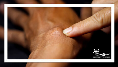 درمان های خانگی کیست گانگلیون دست