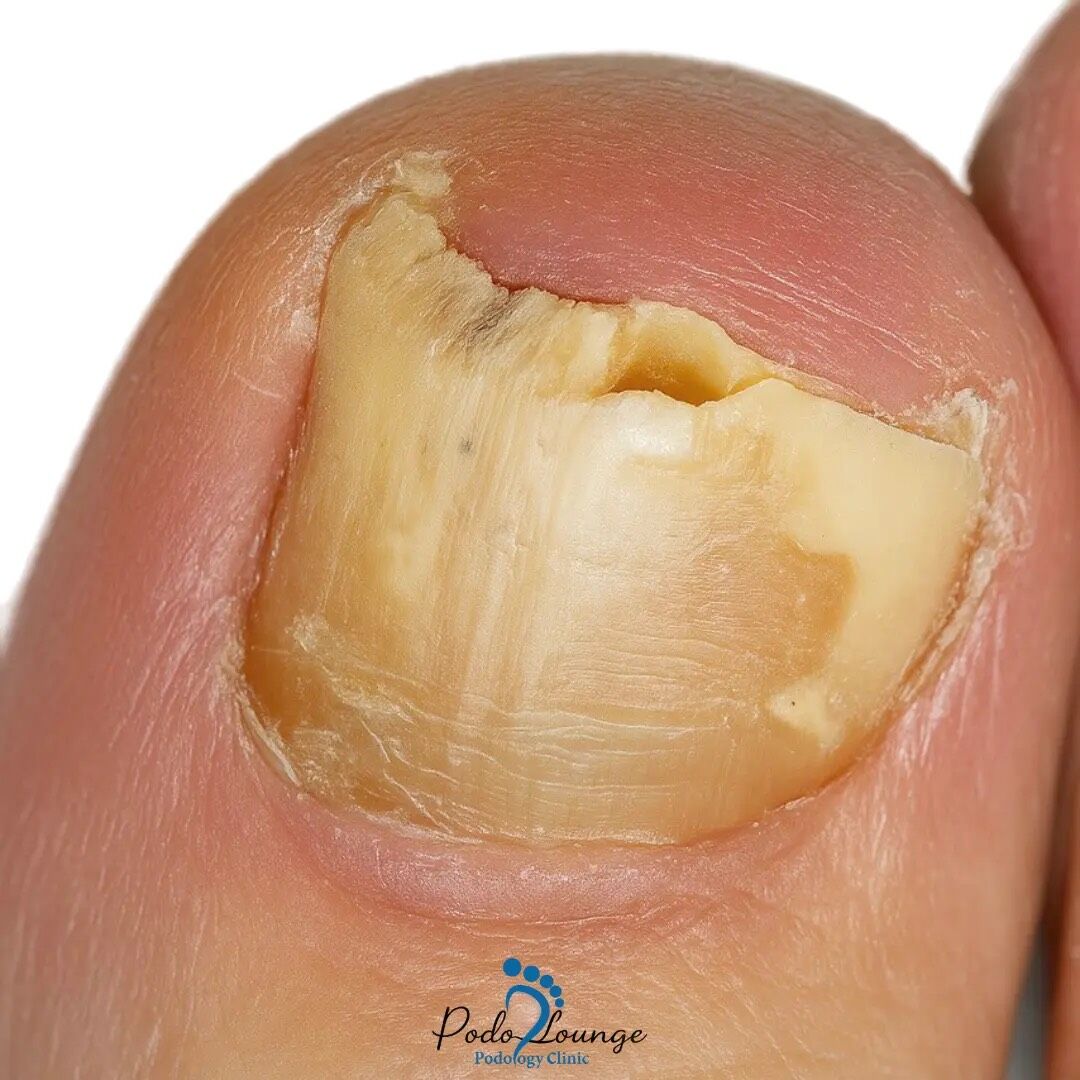 قارچ ناخن علائم، علتها و پیشگیری در مرکز تخصصی پُدولانژ