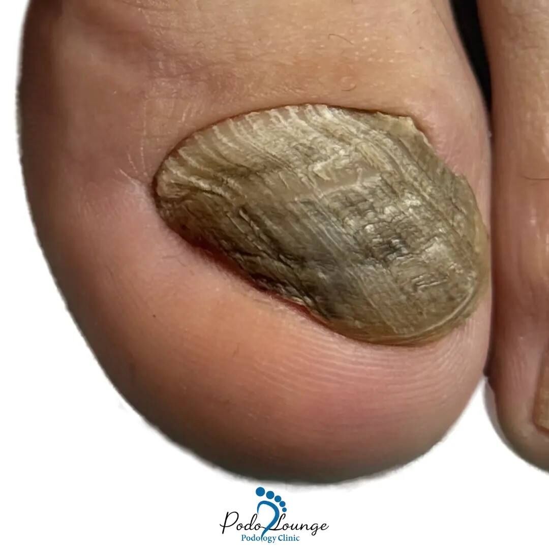 قارچ ناخن علائم، علت‌ها و پیشگیری در مرکز تخصصی پُدولانژ