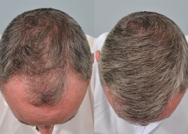 مراقبت بعد از کاشت مو؛ اشتباهاتی که باید اجتناب کرد