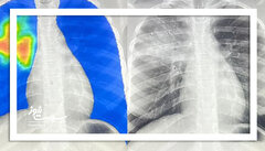 انقلاب هوش مصنوعی در تشخیص سل