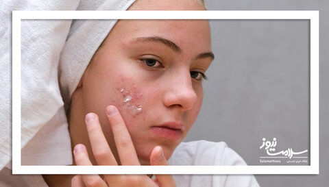 ۵ ترفند مراقبت از پوست برای مقابله با آکنه در فصل سرما