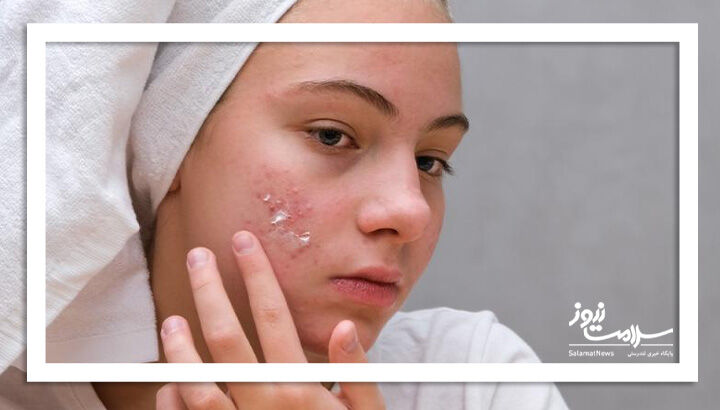 ۵ ترفند مراقبت از پوست برای مقابله با آکنه در فصل سرما