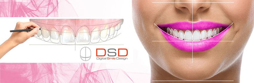 لمینت دندان چیست و لمینت برای چه دندان هایی مناسب است؟