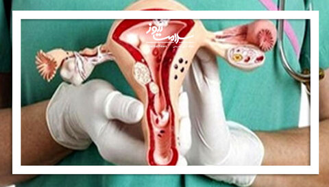 روایت زنانی که با آندومتریوز یک بیماری آزاردهنده درگیرند